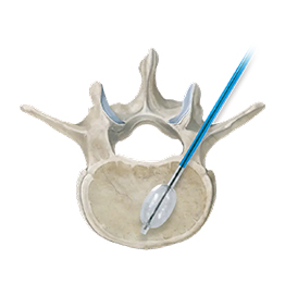 Balloon Kyphoplasty