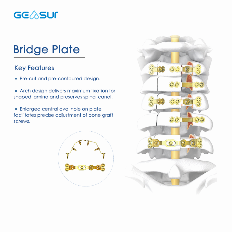 Posterior Cervical Laminoplasty System
