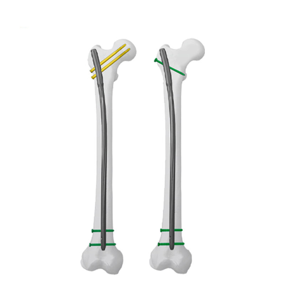 Femoral Expert Intramedullary Nail