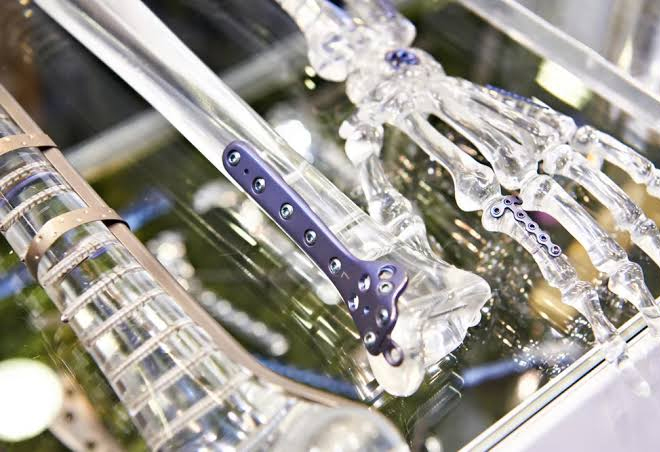 Trauma Orthopedic Implants: A Comprehensive Guide To Materials, Uses, And Surgical Techniques