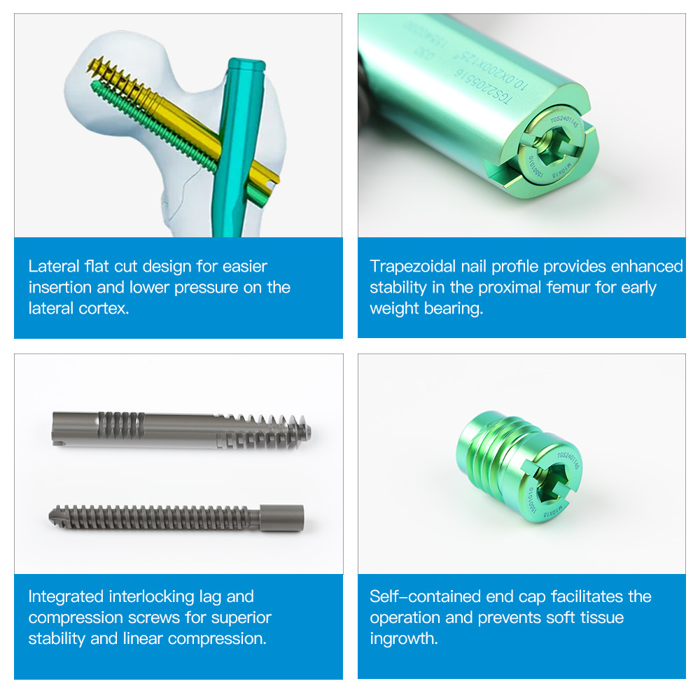 Intertan Intramedullary Nail