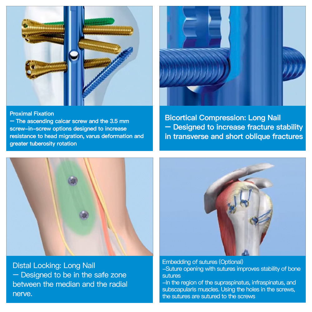 Humeral Intramedullary Nail