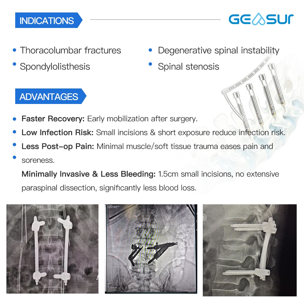 Percutaneous Pedicle Screw