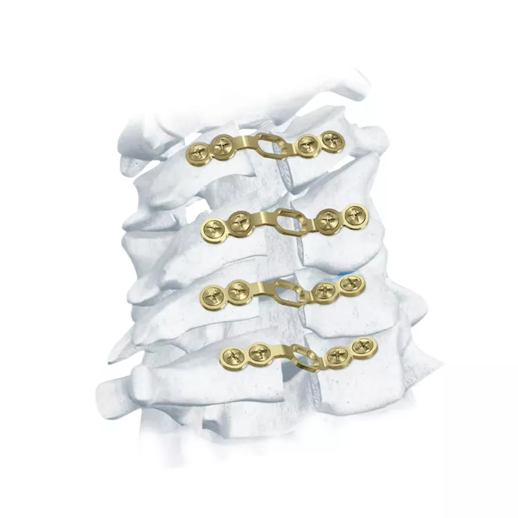 Posterior Cervical Laminoplasty System