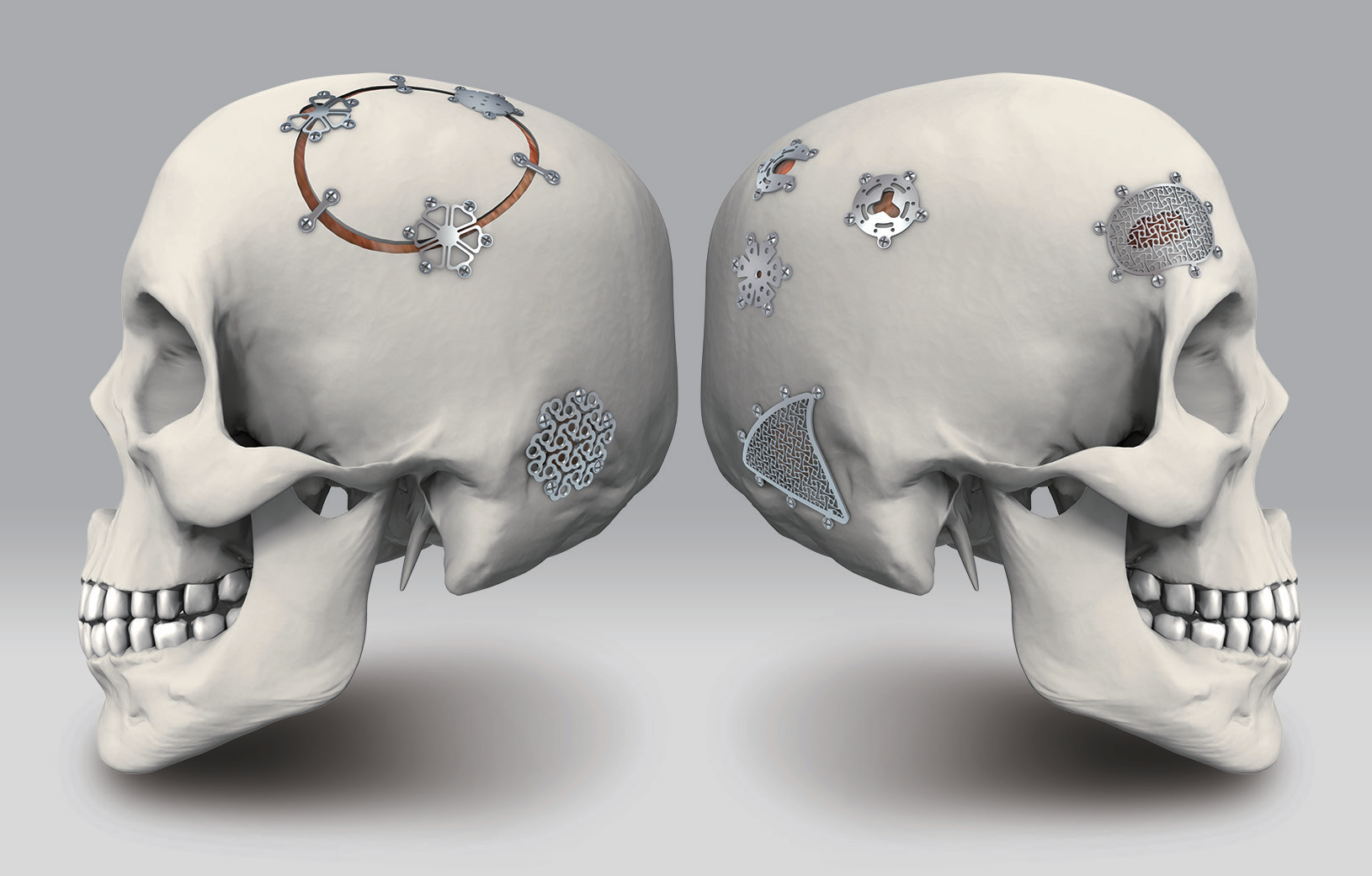 Cranial fixation indications