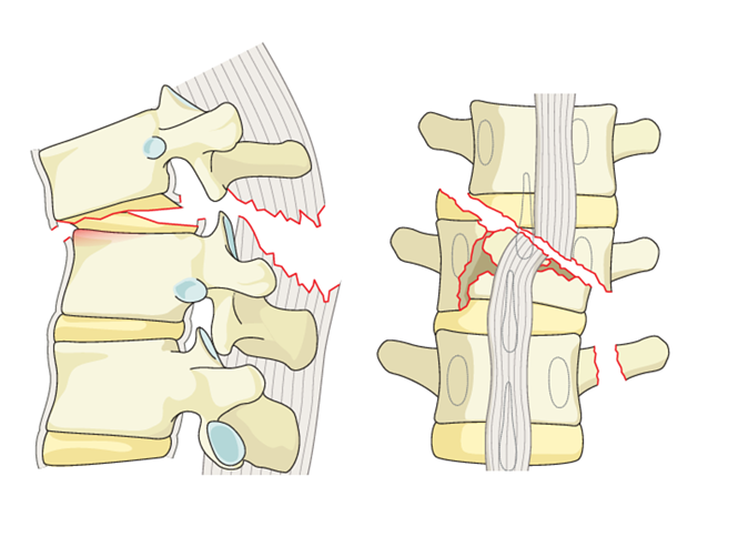 Thoracolumbar fracture