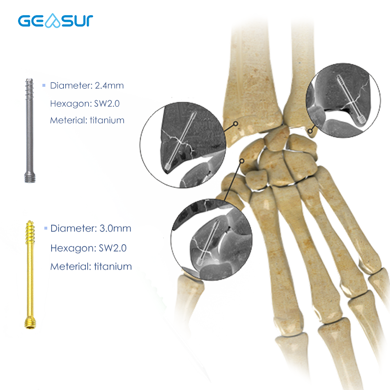 Herbert Screw orthopedic implant by Geasure Medical