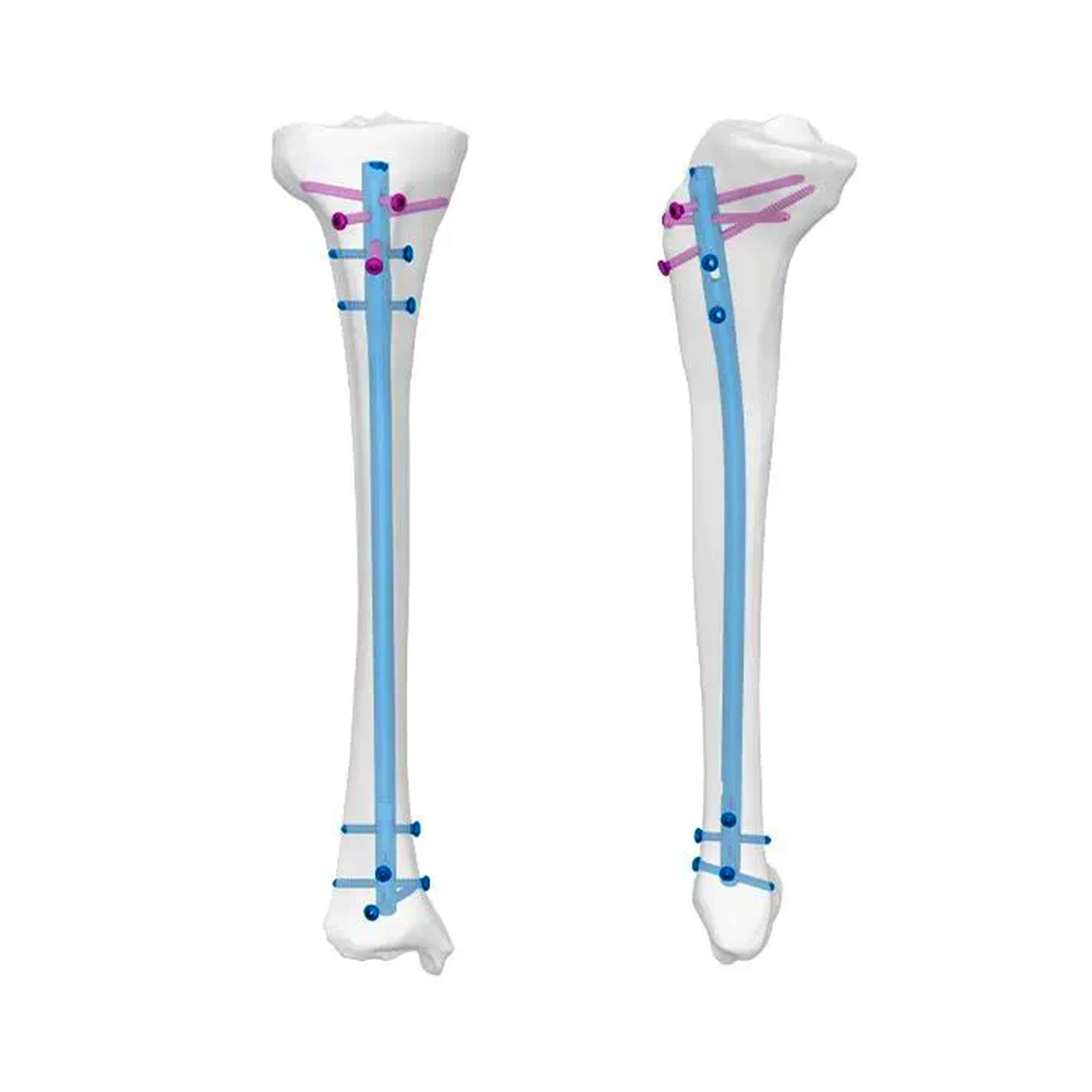 Tibia Intramedullary Nail