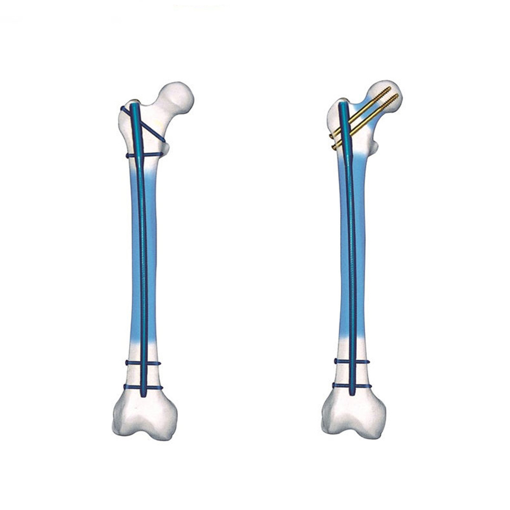 Femoral Expert Intramedullary Nail