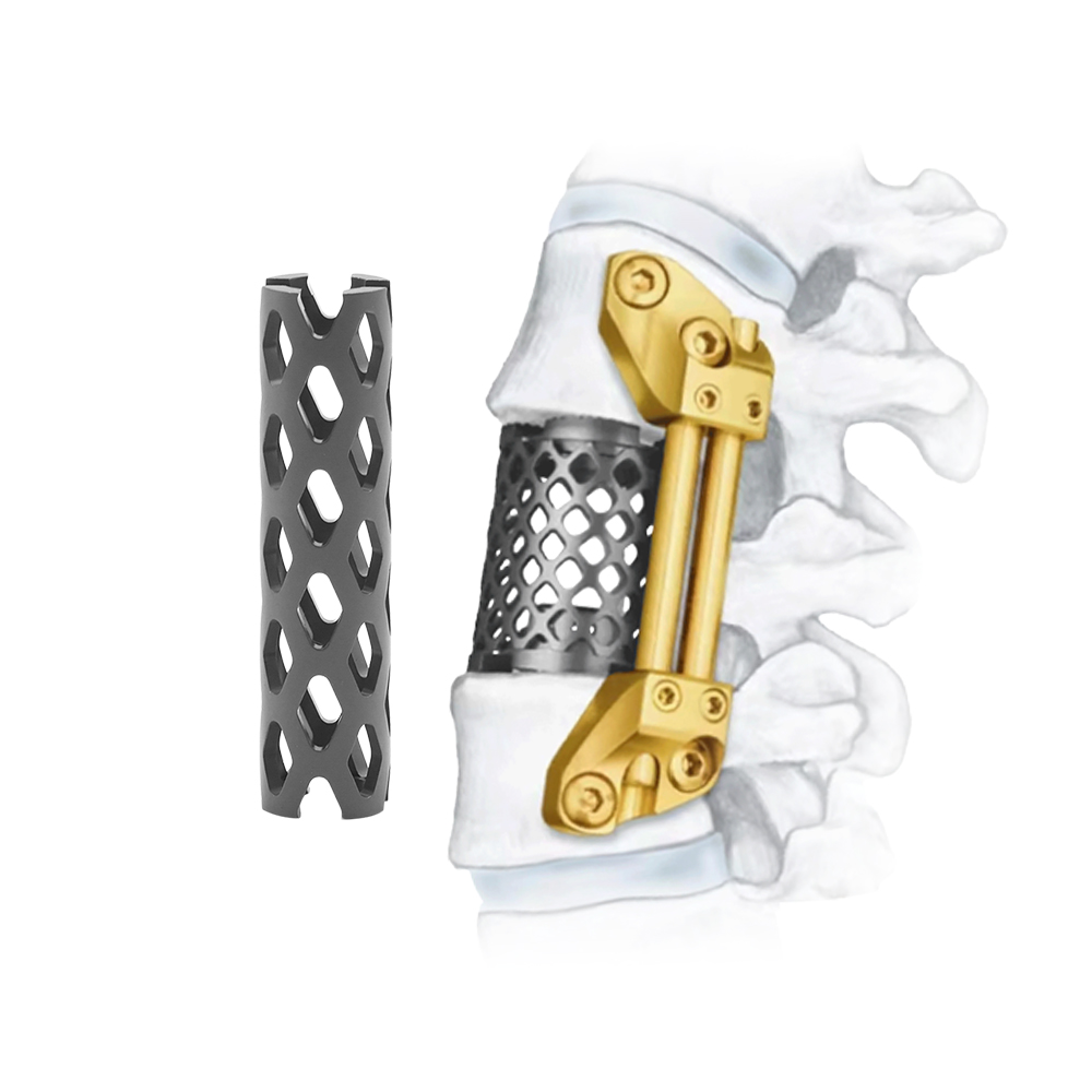 Cervical Titabium Mesh