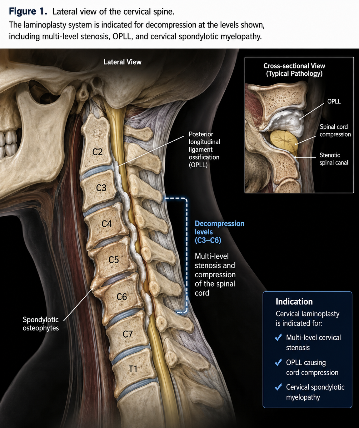 Posterior cervical laminoplasty indication illustration
