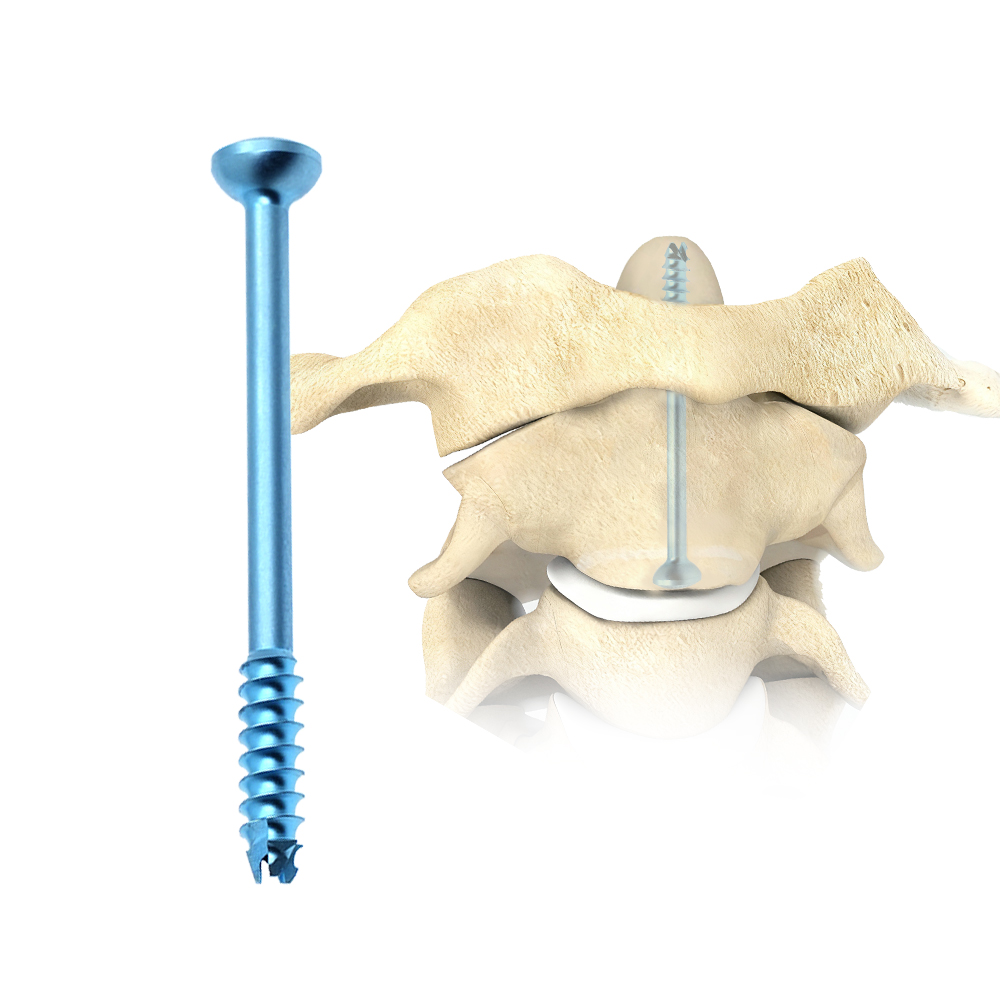 Cervical Cannulated Screw