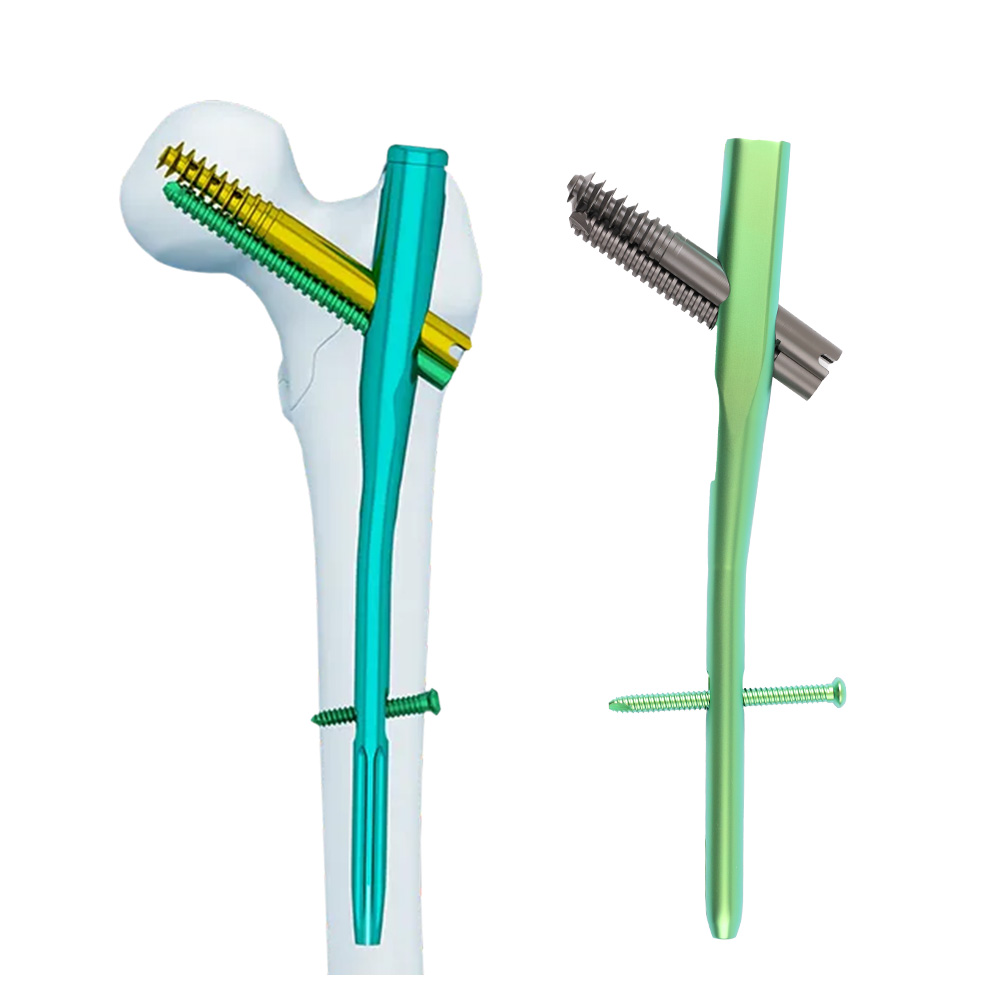 Intertan Intramedullary Nail