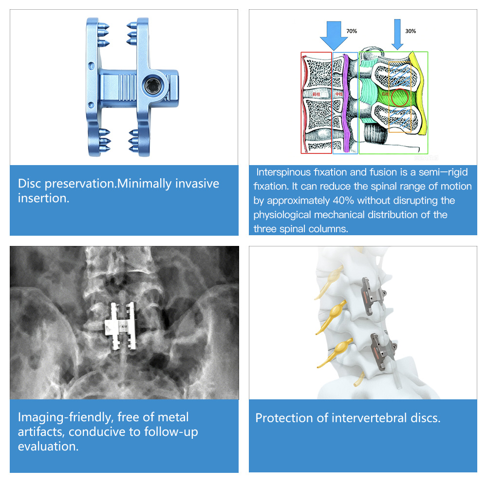 Interspinous Fixation System