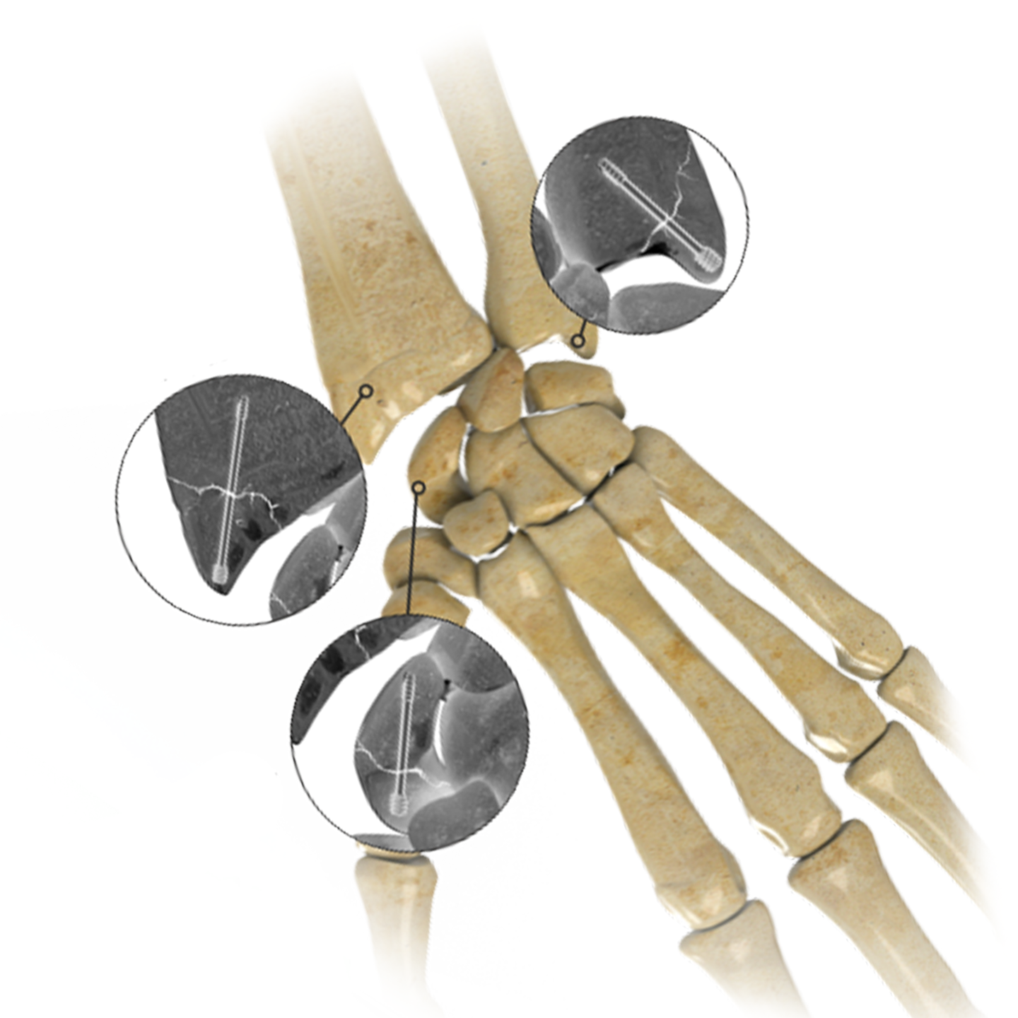 Herbert Screw