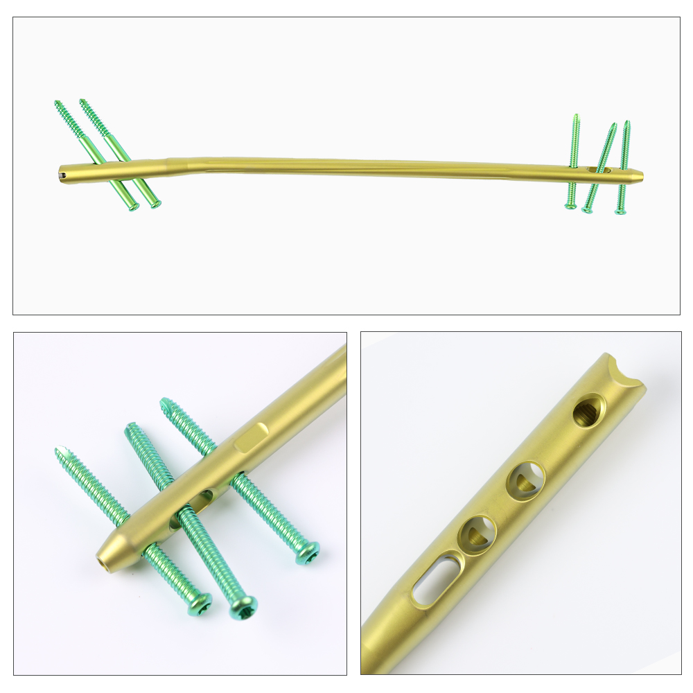 Femoral Expert Intramedullary Nail