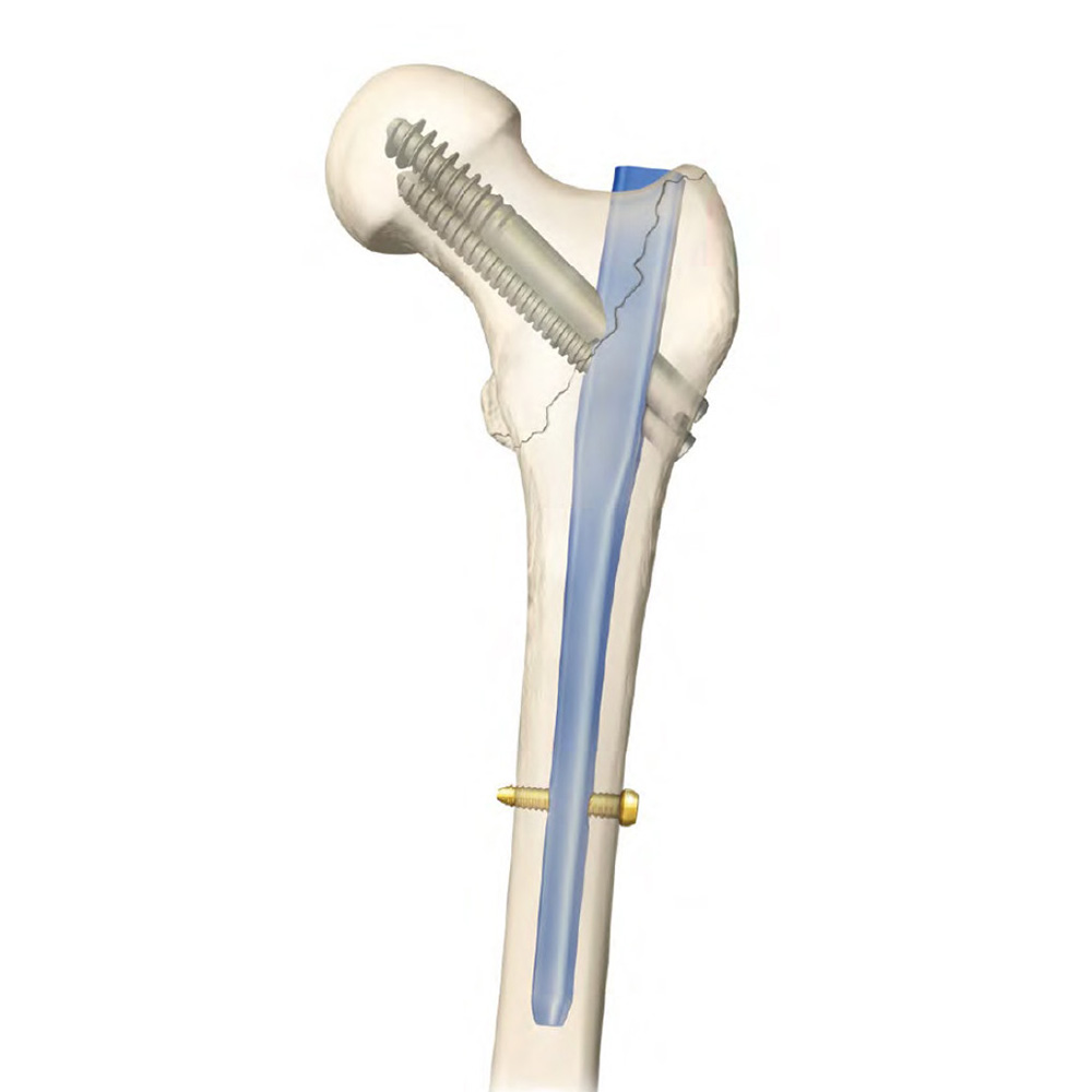 Intertan Intramedullary Nail