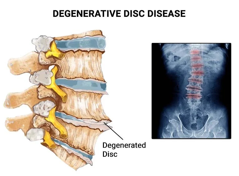 Degenerative Spinal Disorders