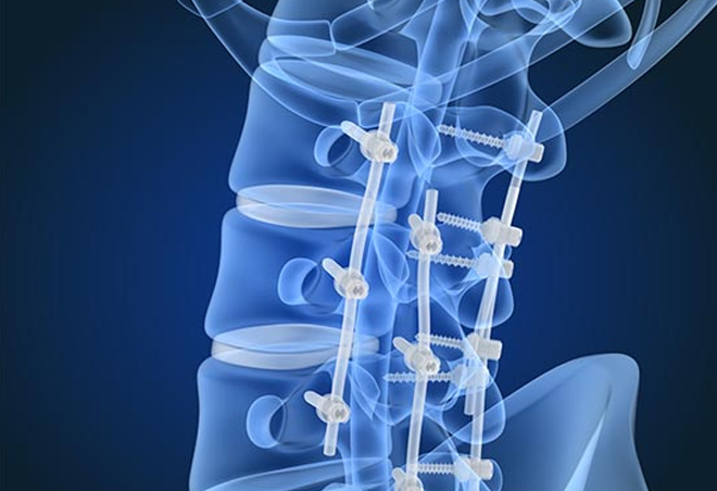 Taking A Closer Look at Orthopaedic Implants