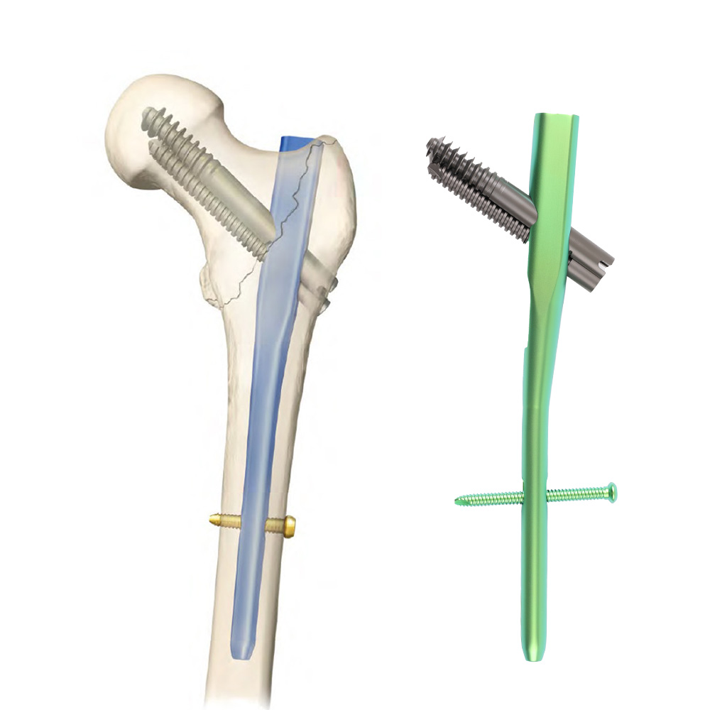 Intertan Intramedullary Nail