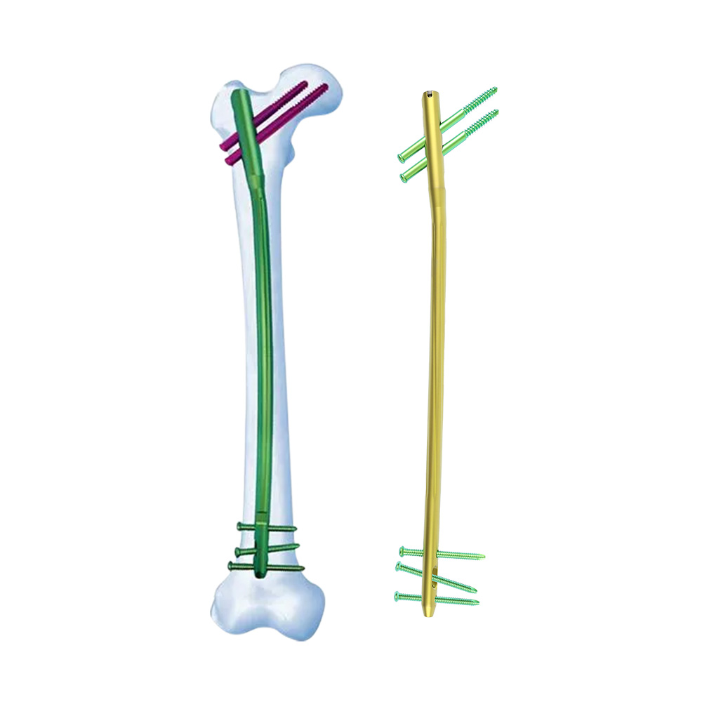 Femoral Expert Intramedullary Nail