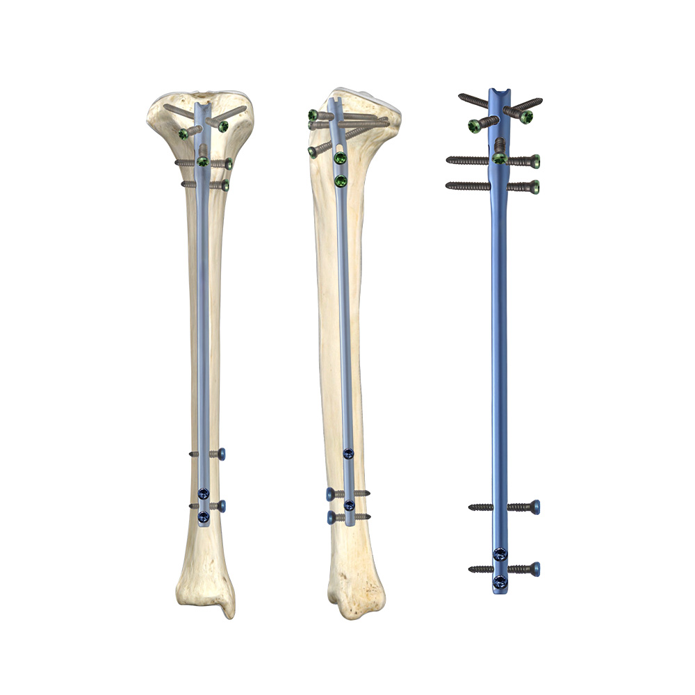 Tibia Intramedullary Nail