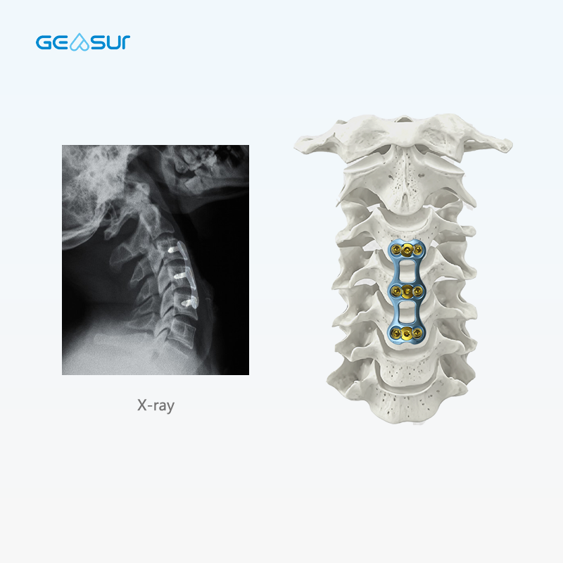 Anterior cervical plate