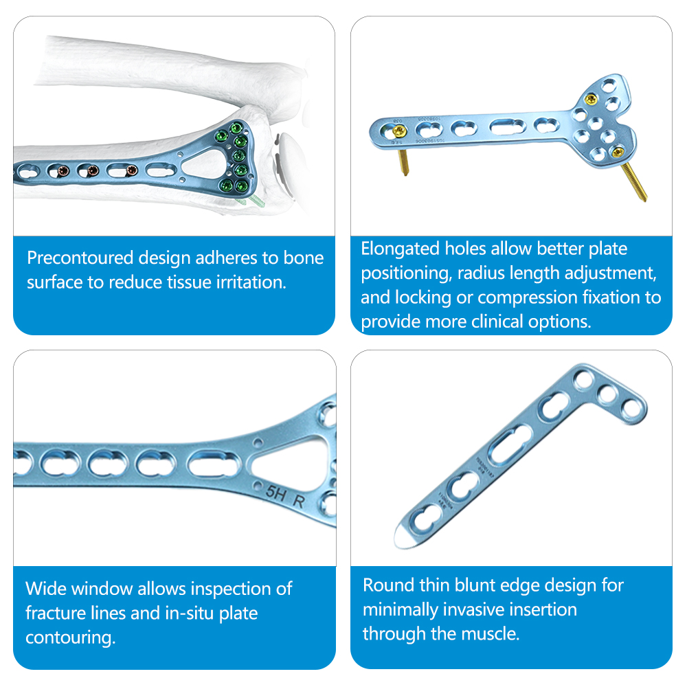 Radius Locking Plate Set