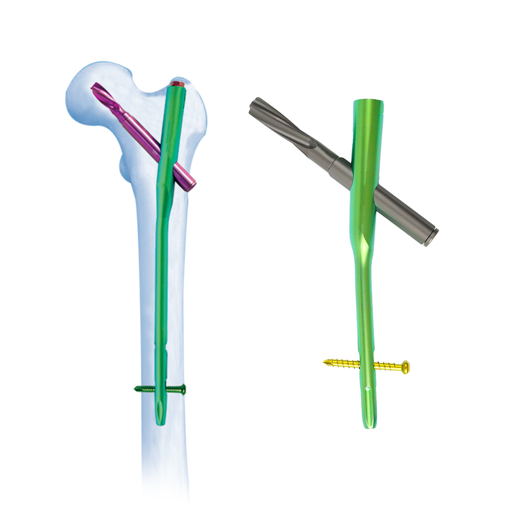 PFNA Intramedullary Nail System
