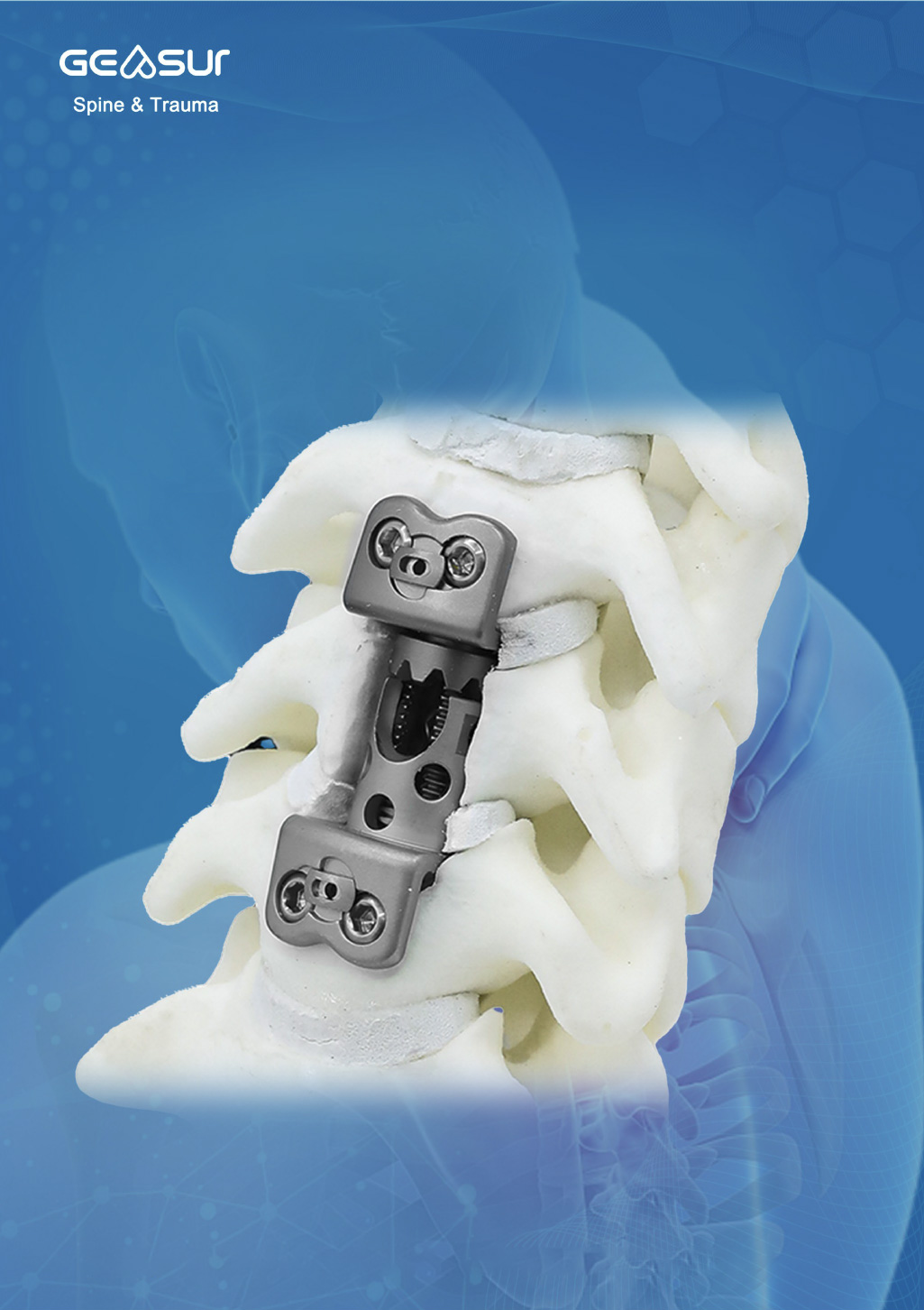 GEASUR Cervical Expandable Titanium Mesh Cage — product poster