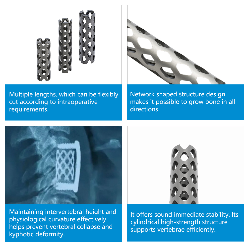 Cervical Titabium Mesh