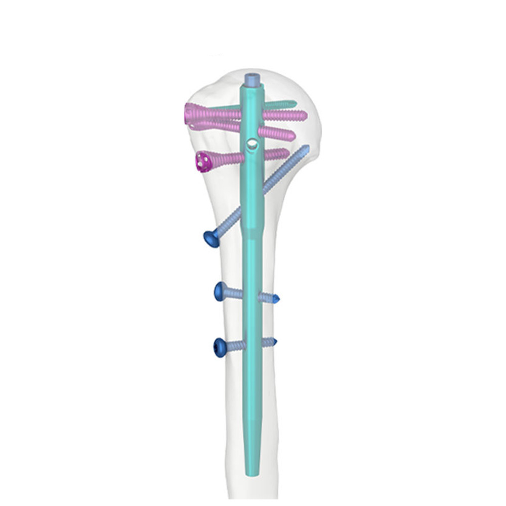 Humeral Intramedullary Nail